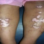 Hypopigmentation Treatment on Legs
