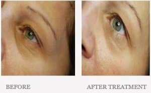 Before & After Dark Circle Eye Treatment