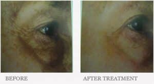 Before & After Treatment to Reduce Dark Circles