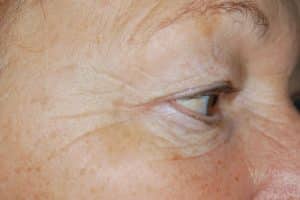 Treatment For Dark Circles Under Eyes