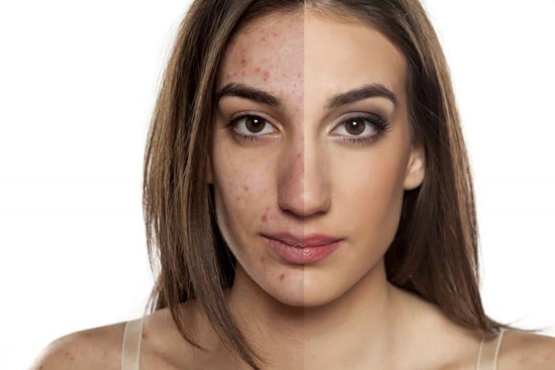 Acne scarring laser resurfacing