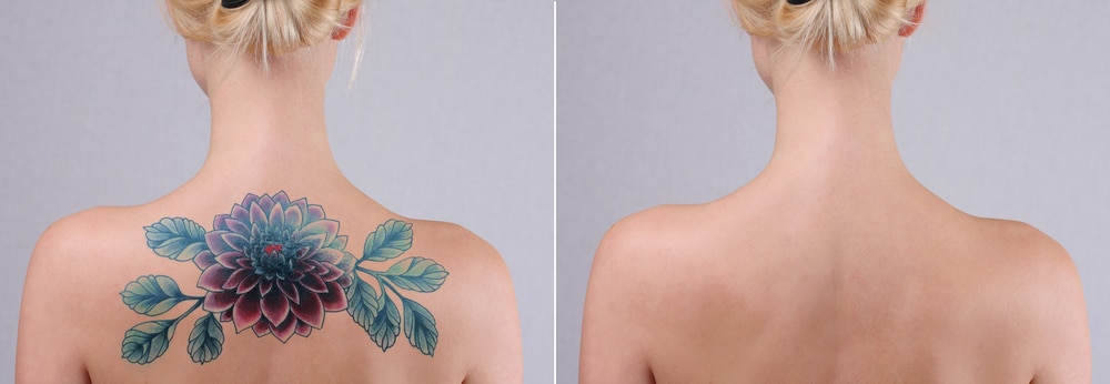 Pico Laser Tattoo Removal