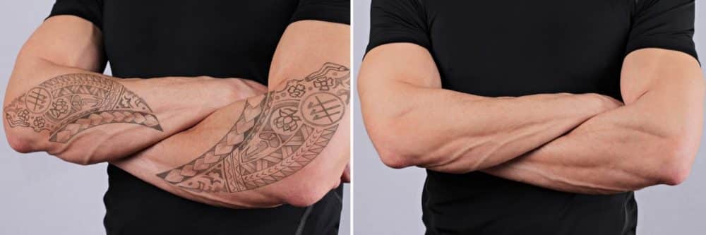 Tattoo Removal  Birmingham Ink Tattoo Studio