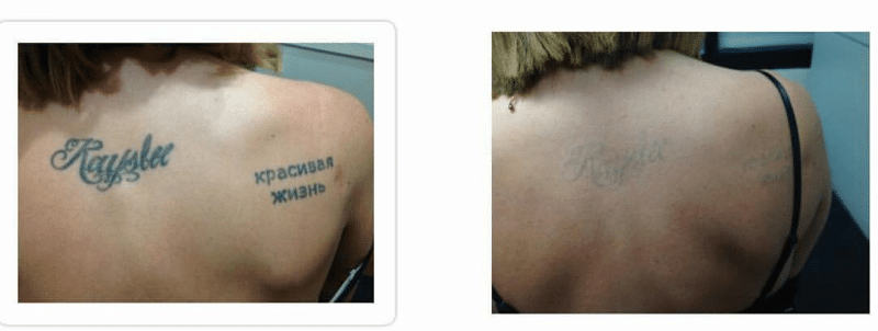 Tattoo removal with Discovery Pico Laser  LAZEO