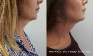 Mini Fx - Secret Faces Clinic