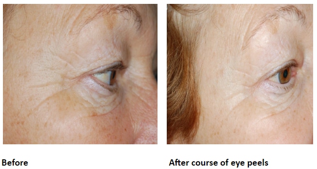 Before and After Course of Eye Peels