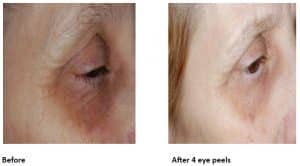 Eye Peel - Before and After