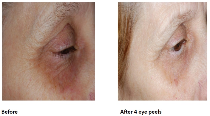 Before and After Course of Eye Peels