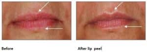 Lip Peel - Before and After