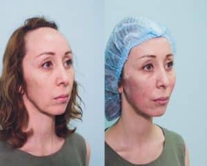 Before and After Non Surgical Face Lift