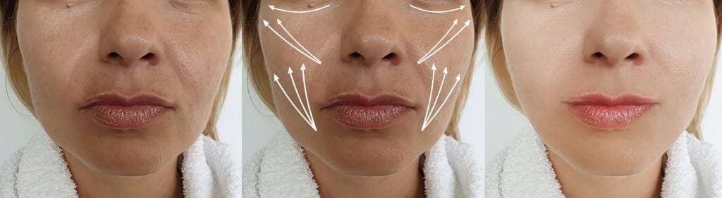 Silhouette Soft Facelift  Solihull Medical Cosmetic Clinic