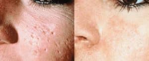 dermaroller for acne scar treatment