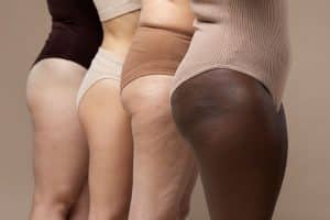 Solihull Medical Cosmetic Clinic Cellulite Treatments Ladies Legs with cellulite