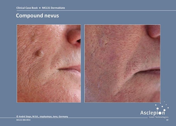 Compound nervus before and after treatment