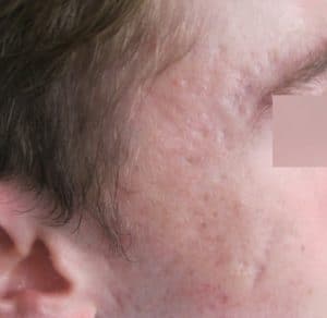 Deep atrophic acne scarring