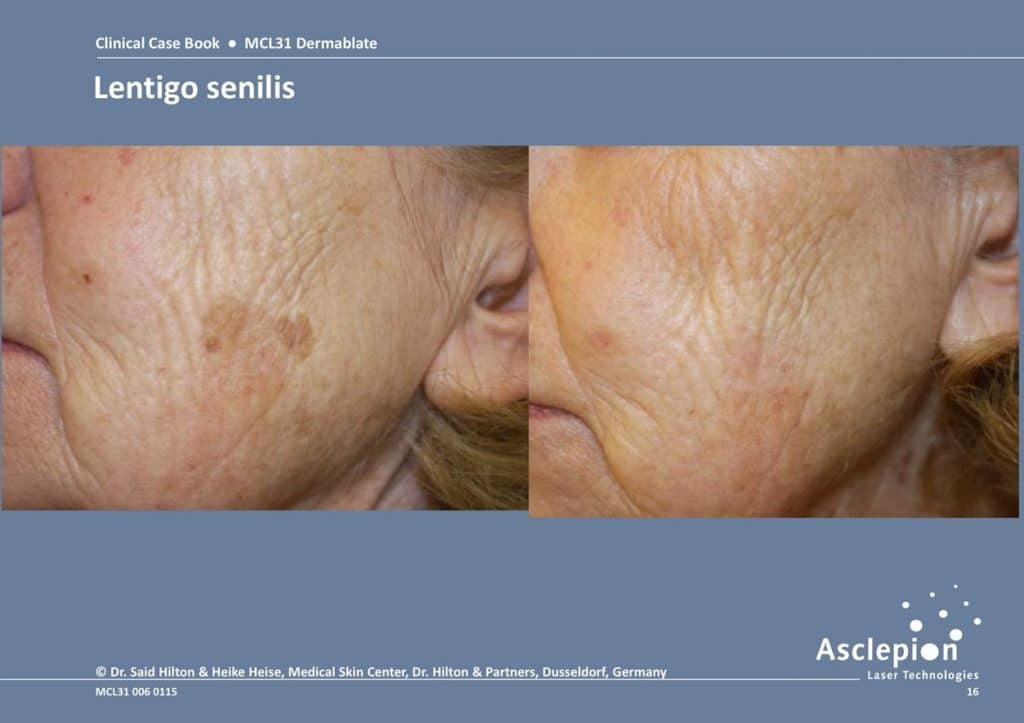 Erbium Yag laser resurfacing | Solihull Medical Cosmetic Clinic