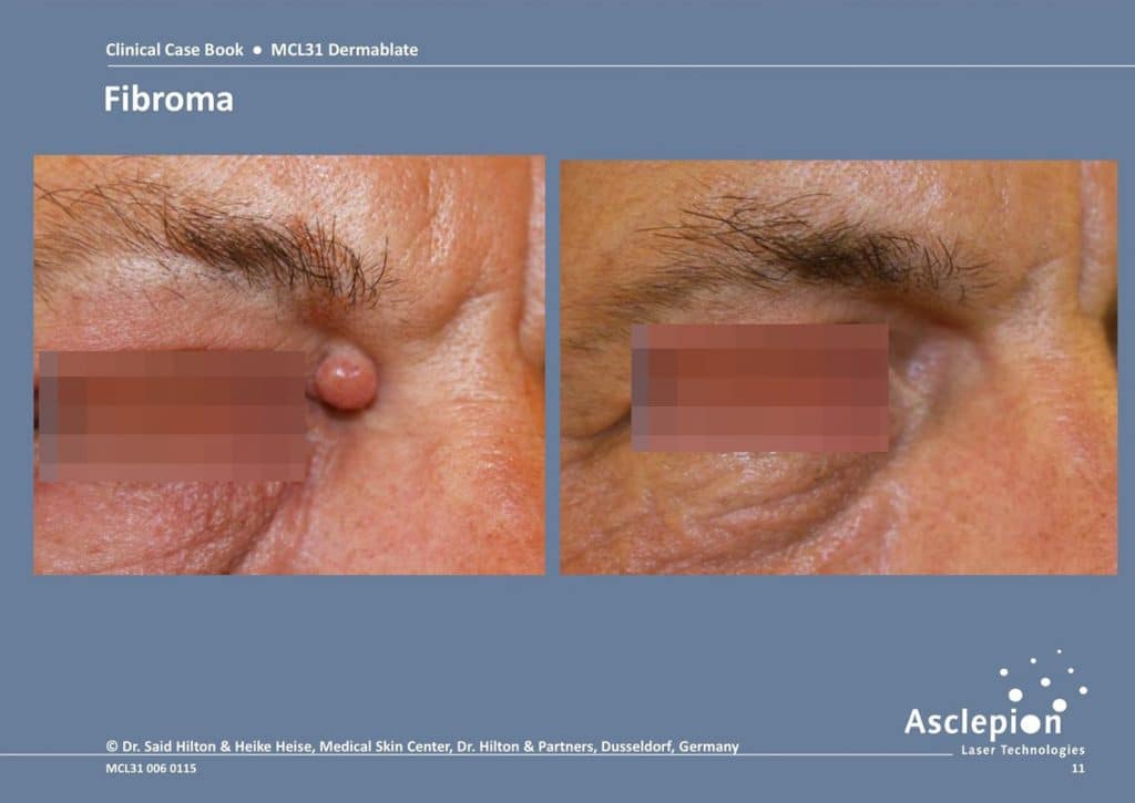 fibroma before and after Erbium Yag laser treament