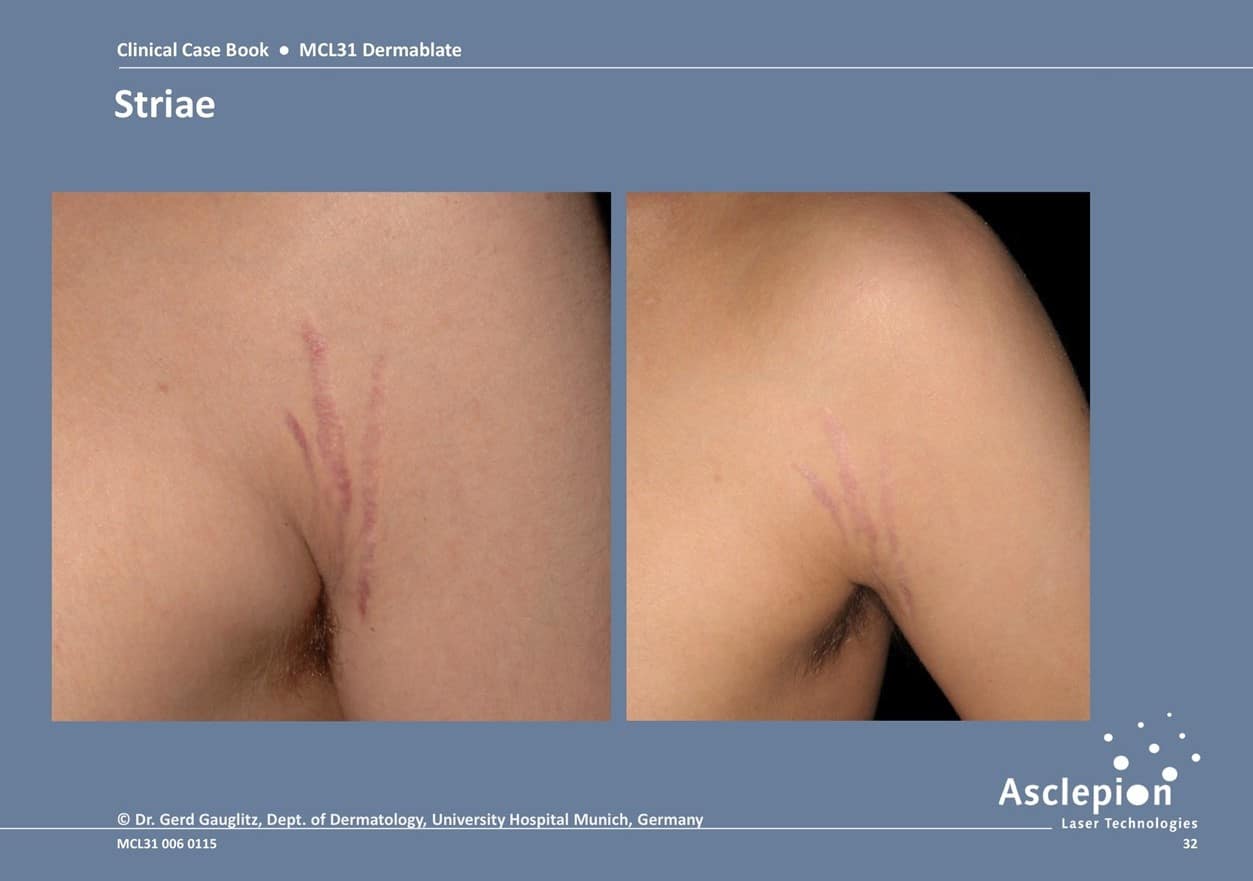 Striae before and after