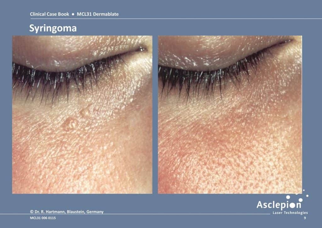 Syringomas before and after treatment
