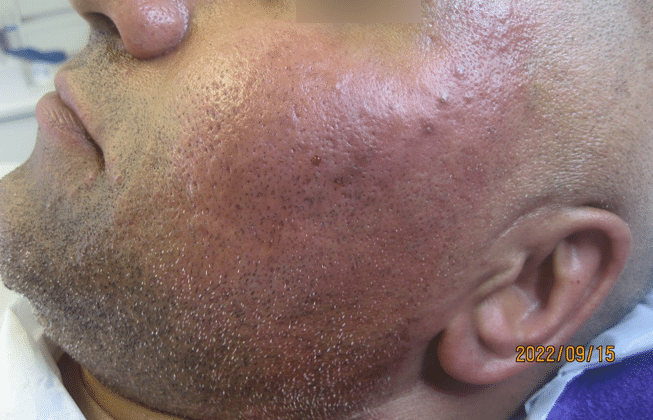 Atrophic acne scarring after one treatment