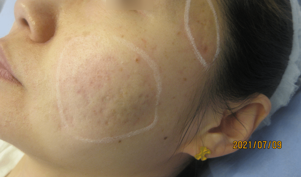 Atrophic acne scarring before treatment