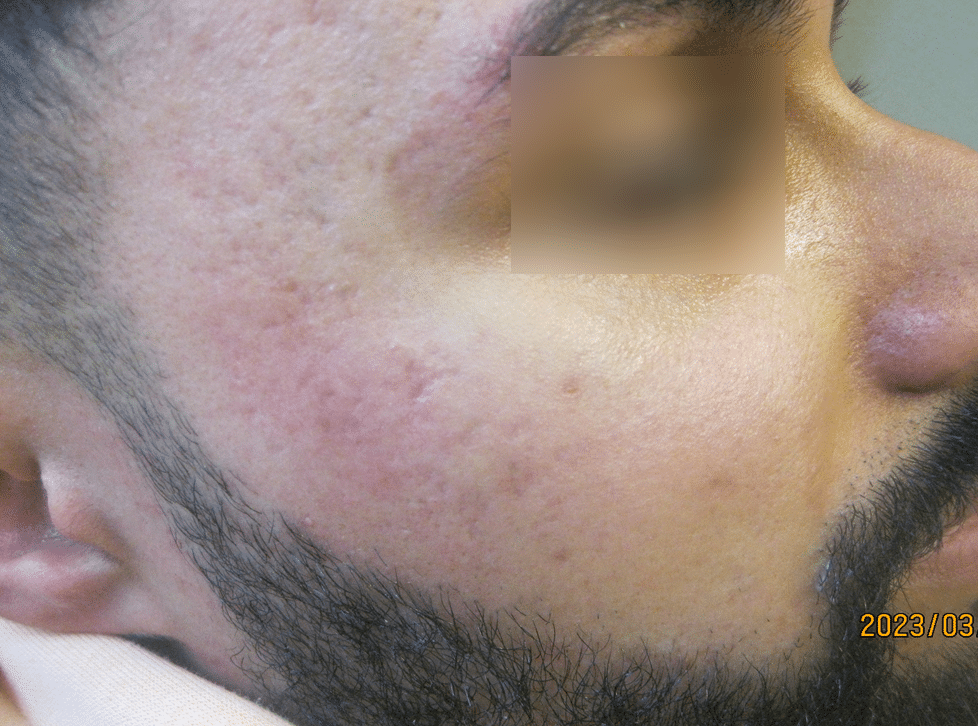 Atrophic and ice-pick acne scarring before treatment