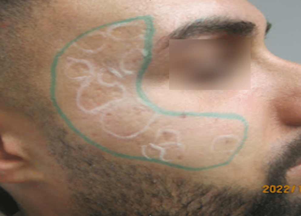 Atrophic and ice-pick acne scarring procedure