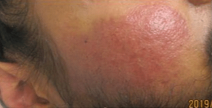 Atrophic and ice pick scarring after treatment