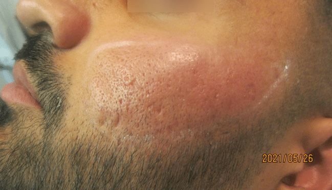 Atrophic and ice pick scarring after