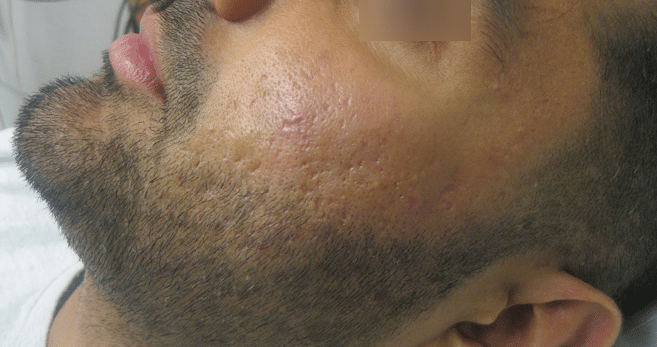 Atrophic and ice pick scarring after treatment