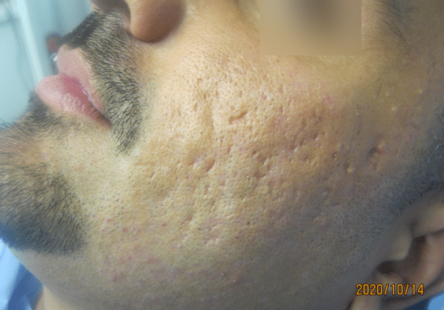 Atrophic and ice pick scarring before treatment