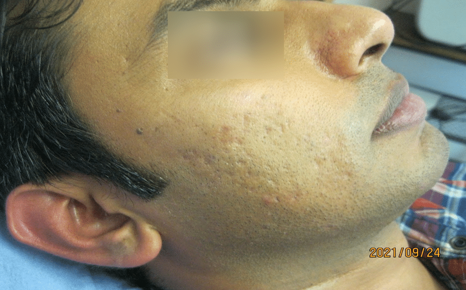 Atrophic scarring before treatment