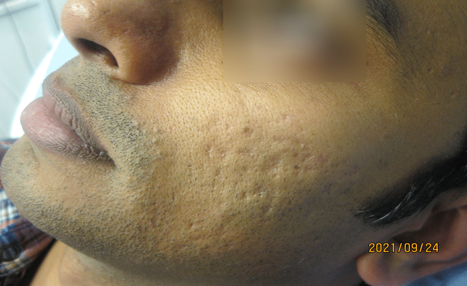 Atrophic scarring before treament