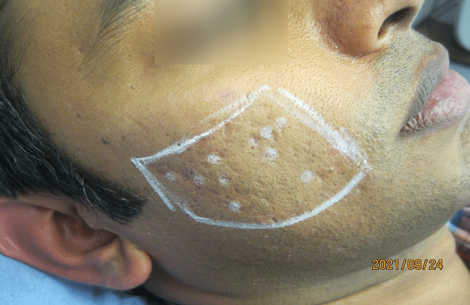 Atrophic scarring pre-mark areas of scarring