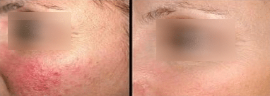 Acne scarring treatment