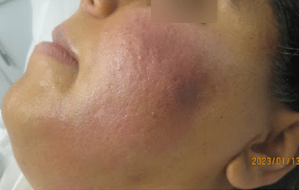 Box type and ice pick scars after treatment