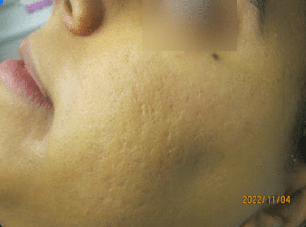 Box type and ice pick scars before treatment