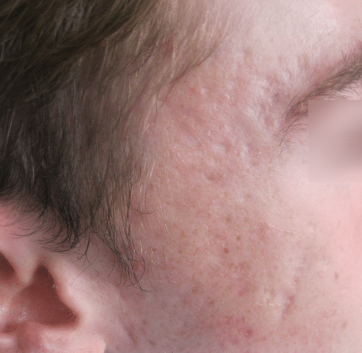 Deep atrophic acne scarring before treatment