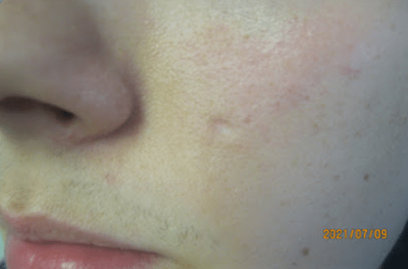 Depressed hypopigmented scar before treatment