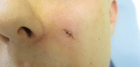 Depressed hypopigmented scar after treatment