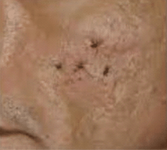 ice pick scar after treatment