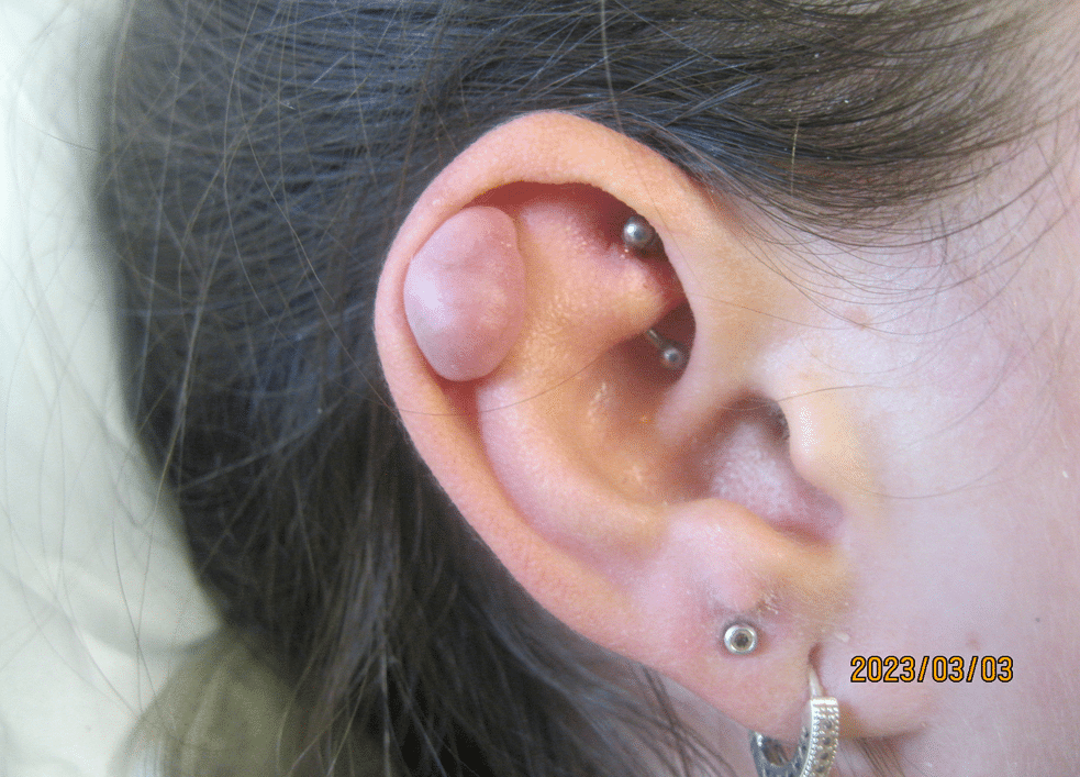 Keloid to ear before treatment