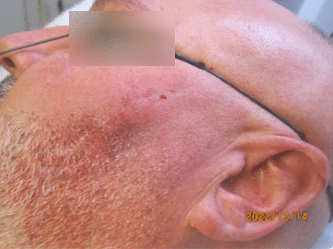 Tethered deep scar after treatment