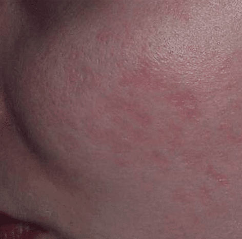 Red acne scarring (PIE) after treatment