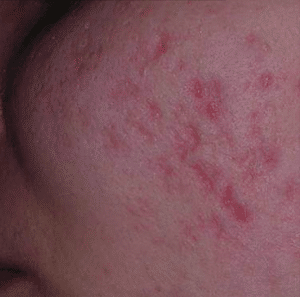 Red acne scarring (PIE) before treatment