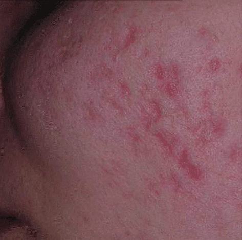 Red acne scarring (PIE) before treatment