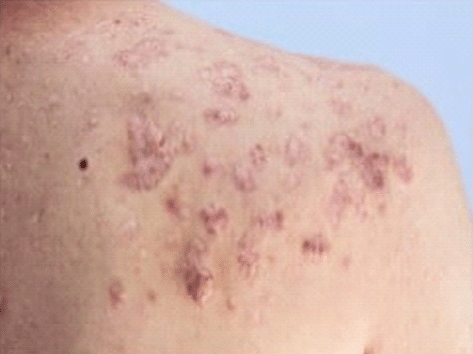 Keloid acne scarring after treatment