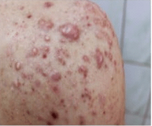 Keloid acne scarring before treatment