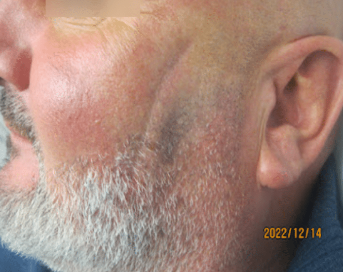 Tethered deep scar before treatment