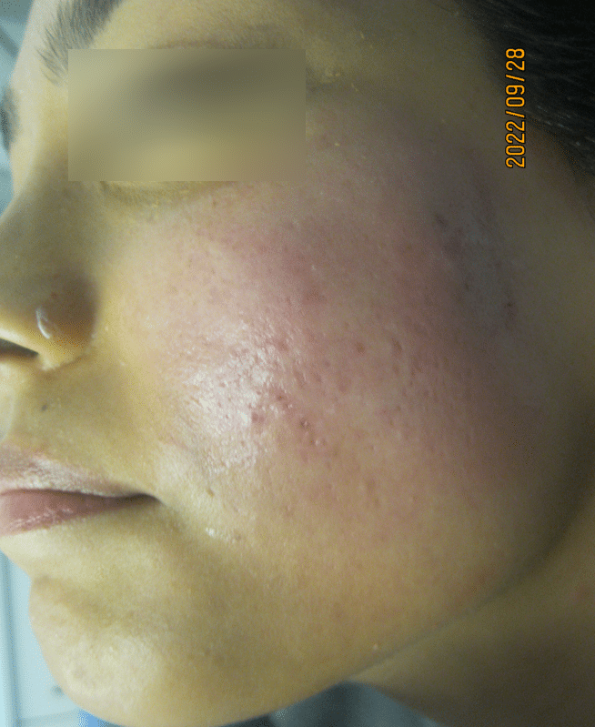 Acne scar after subcision procedure